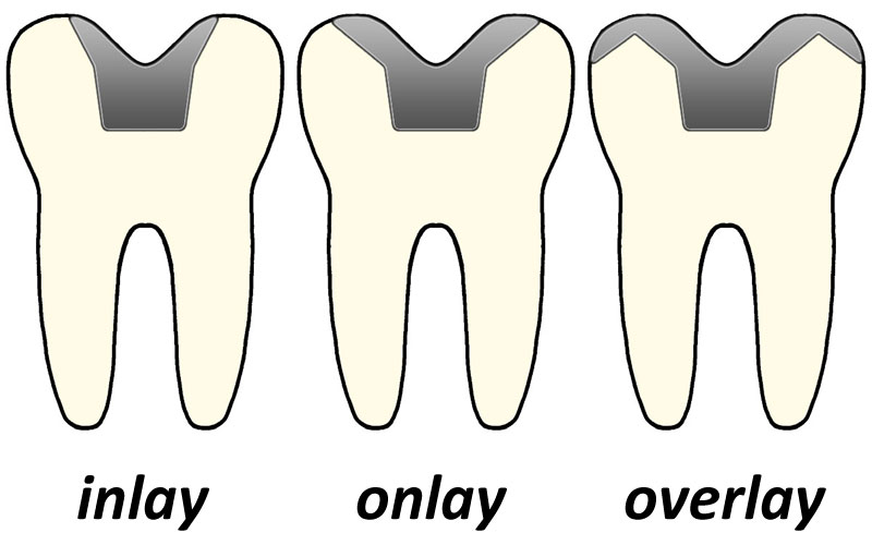 inlay