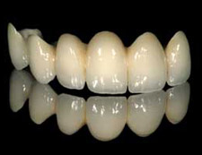 Dental Bridge