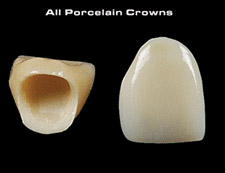 Dental Crown