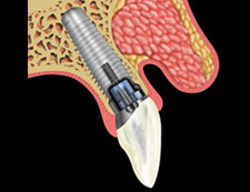 Dental Impalnt